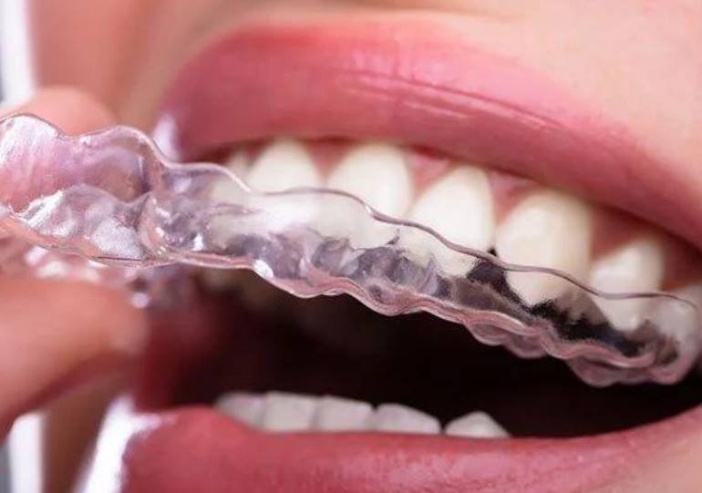 How Much is Invisalign with No Insurance
