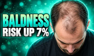 GLP-1 genes extra 7 percent male hair loss risk